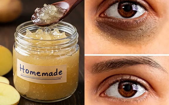 Treat Dark Circles, Sunken Eyes & Puffy Eyes with Home Remedies and Eye Creams