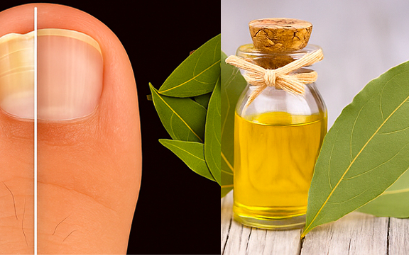 Bay Leaves for Nail Fungus: A Natural Remedy That Works