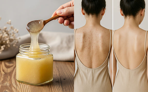 14 simple home remedies that may help you fight acne naturally