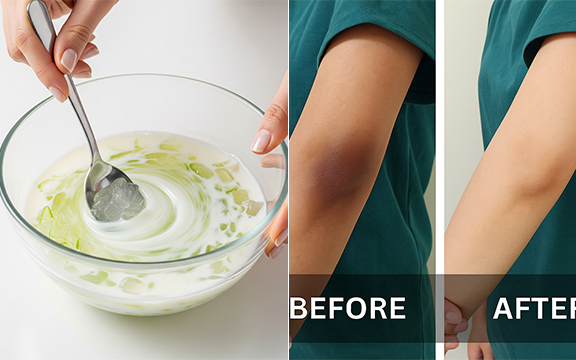 Brighten Dark Elbows and Knees: Try These 3 Easy DIY Hacks